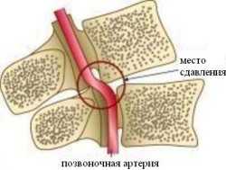Гипоплазия правой позвоночной артерии