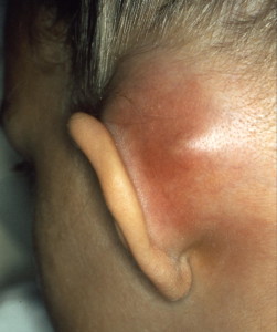 Mastoiditis1