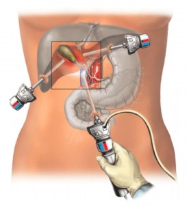 gallbladder-ops-02