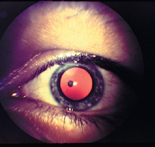 Врожденная катаракта глаза