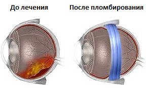 otsloyka-setchatki-lechenie