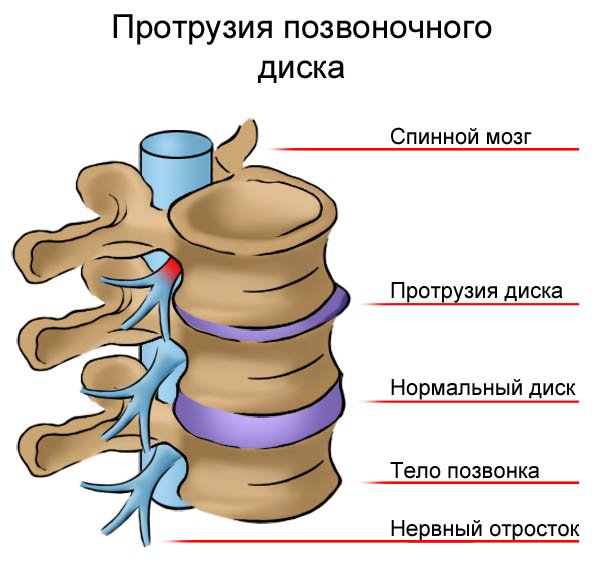 Миниинвазивный метод лечения межпозвонковой грыжи thumbnail