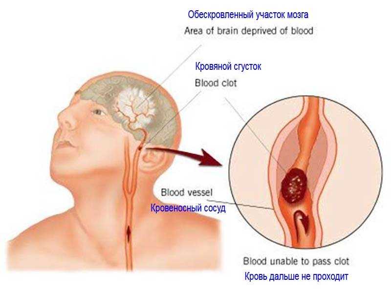 Медицинская классификация инсультов