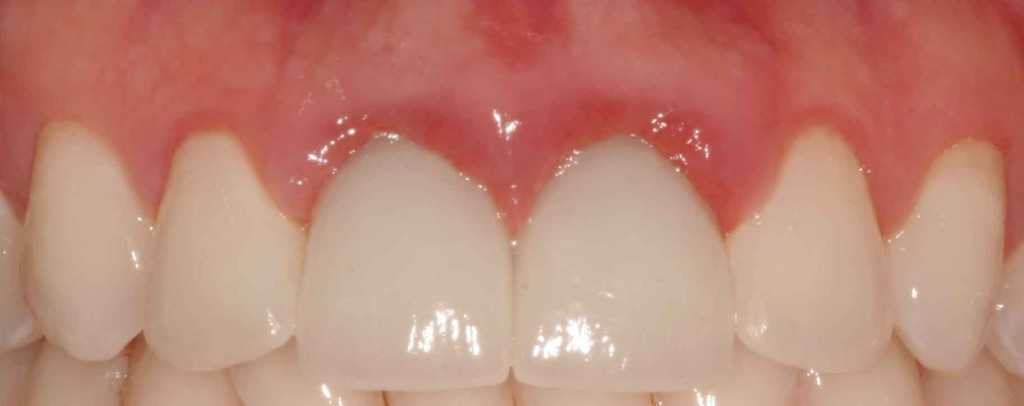 Red-swollen-gums