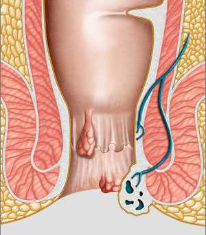 Лечение геморро