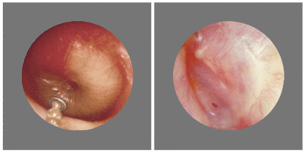 tympanostomy_tube-37_171