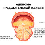 аденома