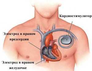 Кардиостимулятор