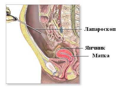 Лапароскопия брюшной полости