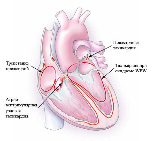 Тахикардия