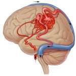 артериовенозной мальформации сосудов головного мозга