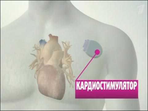 Противопоказания к имплантации кардиостимулятора thumbnail