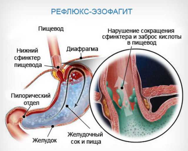 рефлюкс эзо