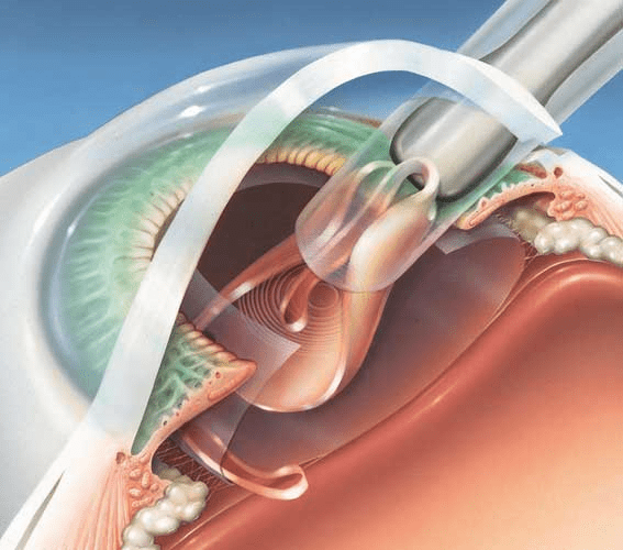 Удаление катаракты методом экстракапсулярной экстракции