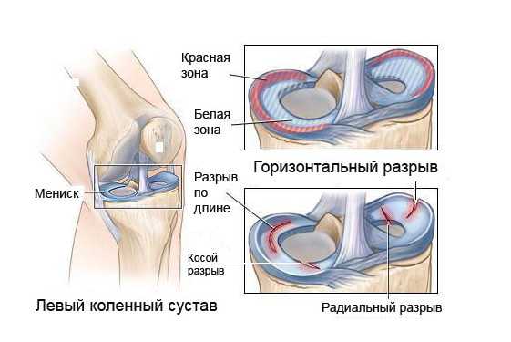 Мениск коленного сустава
