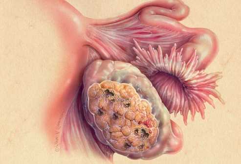 Рак яичников - симптомы, стадии, диагностика