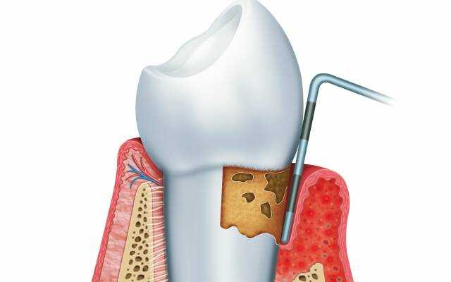 Гнойный пародонтит