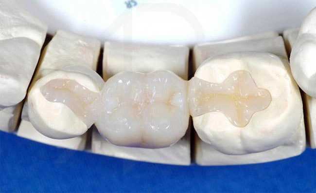 Что такое зубные вкладки – виды и их особенности