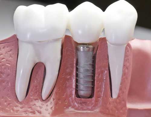 Как проводится имплантация зубов