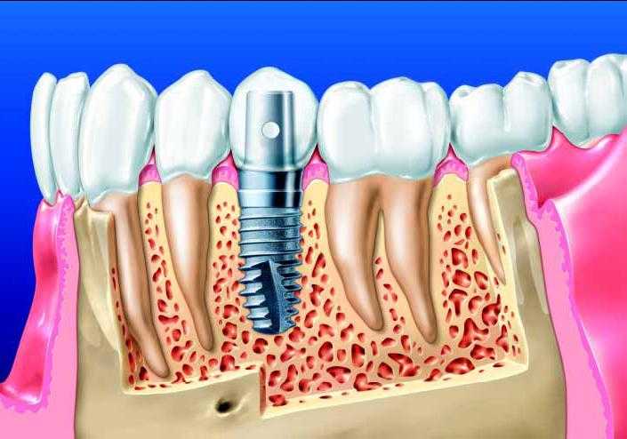 Имплантация зубов после удаления