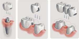 Протезирование зубов на имплантах