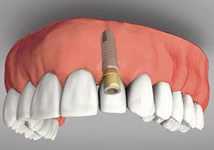 Имплантация и имланты передних зубов
