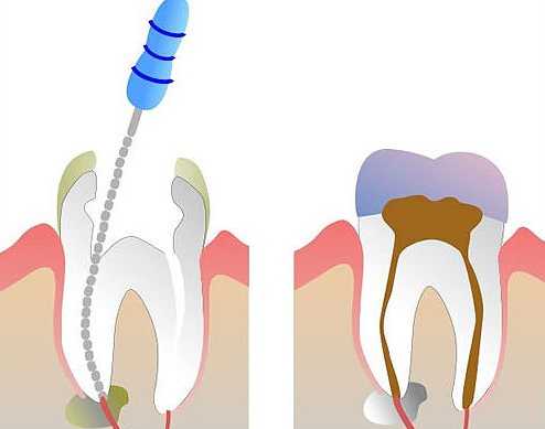 Депульпирование - последствия удаления пульпы зуба