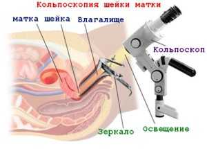 Как и где проводится кольпоскопия шейки матки?