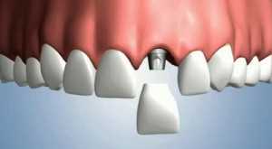 Имплантация и имланты передних зубов – как сделать зону улыбки привлекательной?