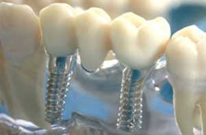Имплантация или протезирования зубов – все за и против