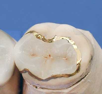Что такое зубные вкладки – виды и их особенности
