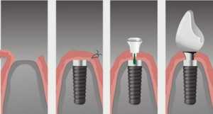 Как проводится имплантация зубов