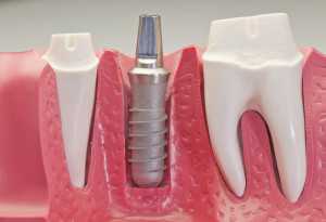 Имплантация или протезирования зубов – все за и против