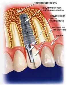 Имплантация зубов после удаления