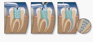 Депульпирование - последствия удаления пульпы зуба