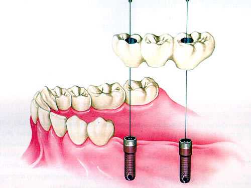 Базальная имплантация зубов