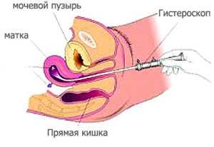 гистероскоп