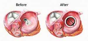 Замена митрального клапана