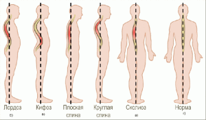 Основные методы лечение остеохондроза пояснично-крестцового отдела позвоночника