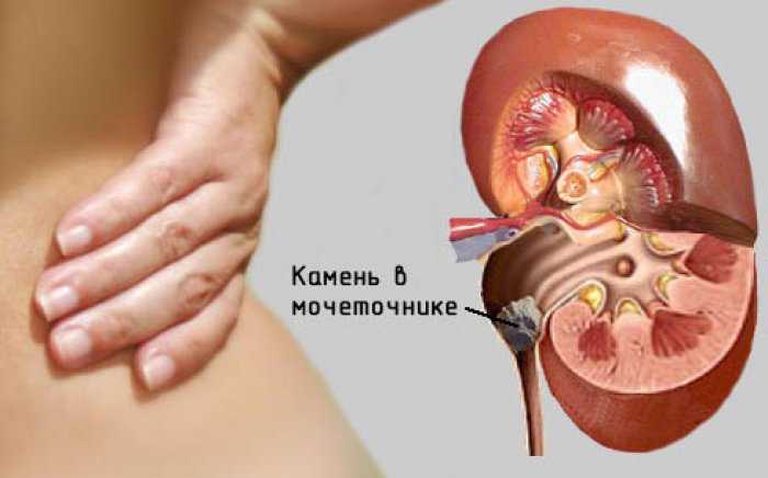 Методы лечения камней в мочеточнике у мужчин и у женщин