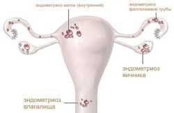 Эндометриоз - диагностика
