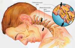 Причины появления остеохондроза шейного отдела позвоночника thumbnail