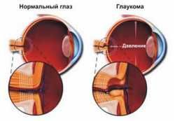 Формы глаукомы