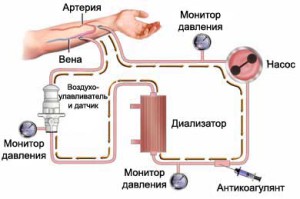 Процедура гемодиализа