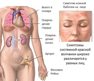 Органы, поражаемые волчанкой