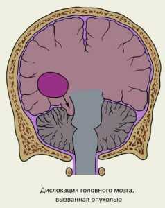 Церебральная дислокация