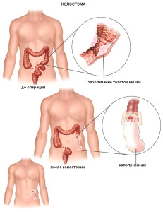 Наложение колостомы