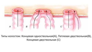 Типы трансверзостом