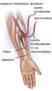 Фистула на руке