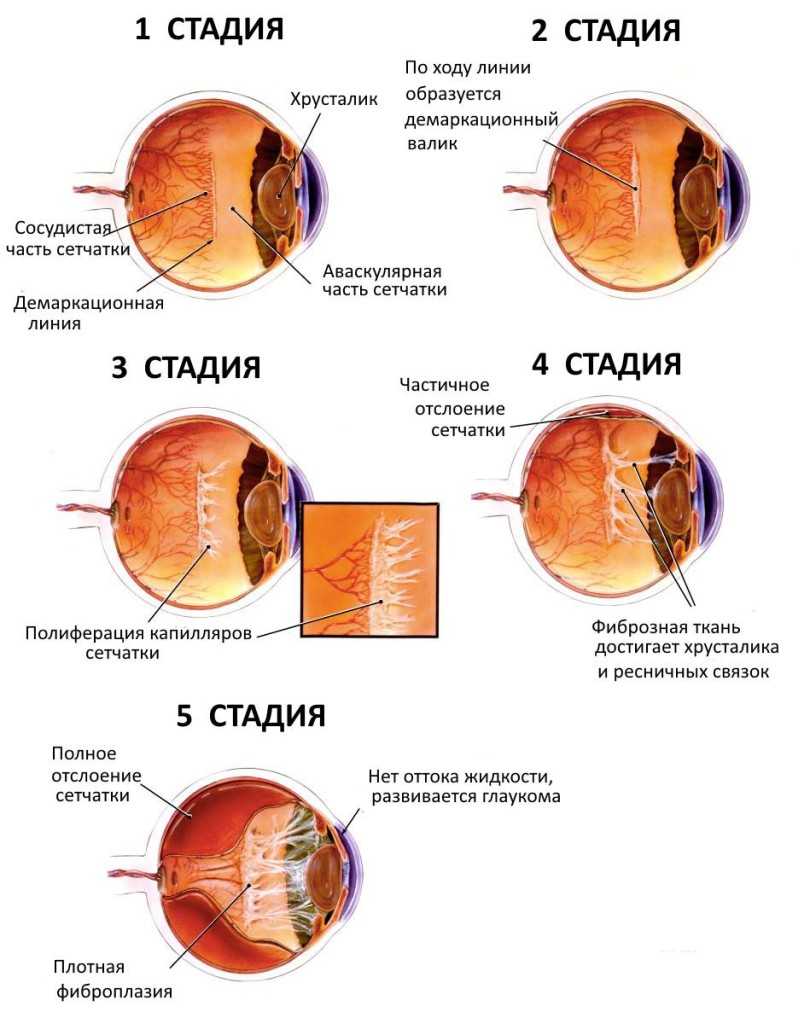 Стадии ретинопатии